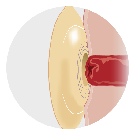 Convex barrier pressure