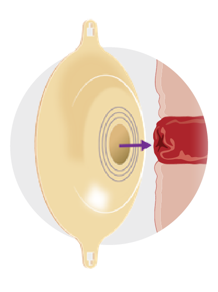 Position skin barrier above flush stoma